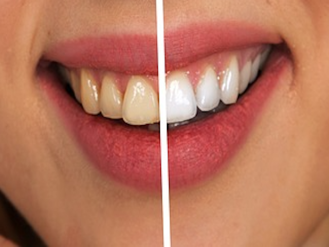 Diş Beyazlatma Ürünleri Yarardan Çok Zarar Veriyor Olabilir